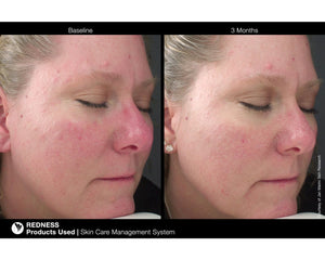 RosaLieve Redness Reducing Complex