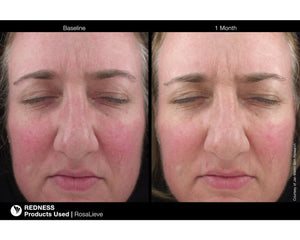 RosaLieve Redness Reducing Complex