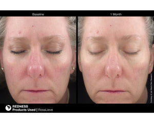 RosaLieve Redness Reducing Complex